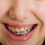 Tips for Parents: Helping Your Kid Cope With Dental Braces