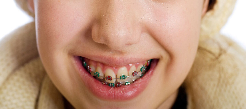 Tips for Parents: Helping Your Kid Cope With Dental Braces